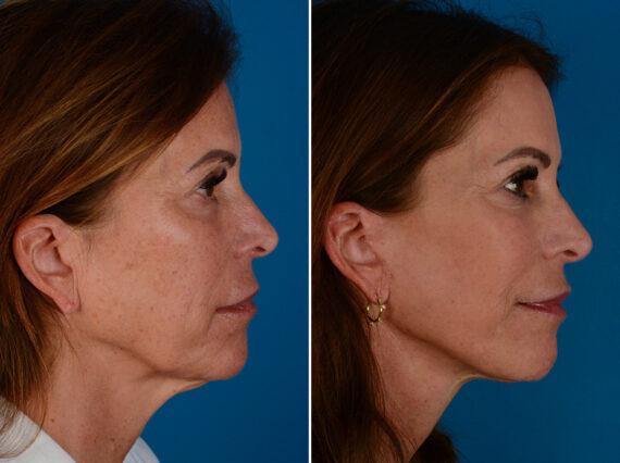 The UpLift™ Lower Face and Neck Lift Before and After Photos in Naples, FL, Patient 26037