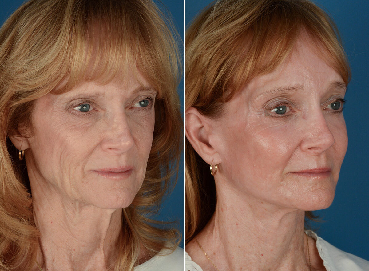 Cheek Implants Before and After Photos in Naples, FL, Patient 26083