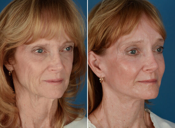 Cheek Implants Before and After Photos in Naples, FL, Patient 26083