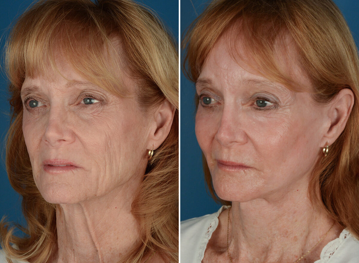 Cheek Implants Before and After Photos in Naples, FL, Patient 26083