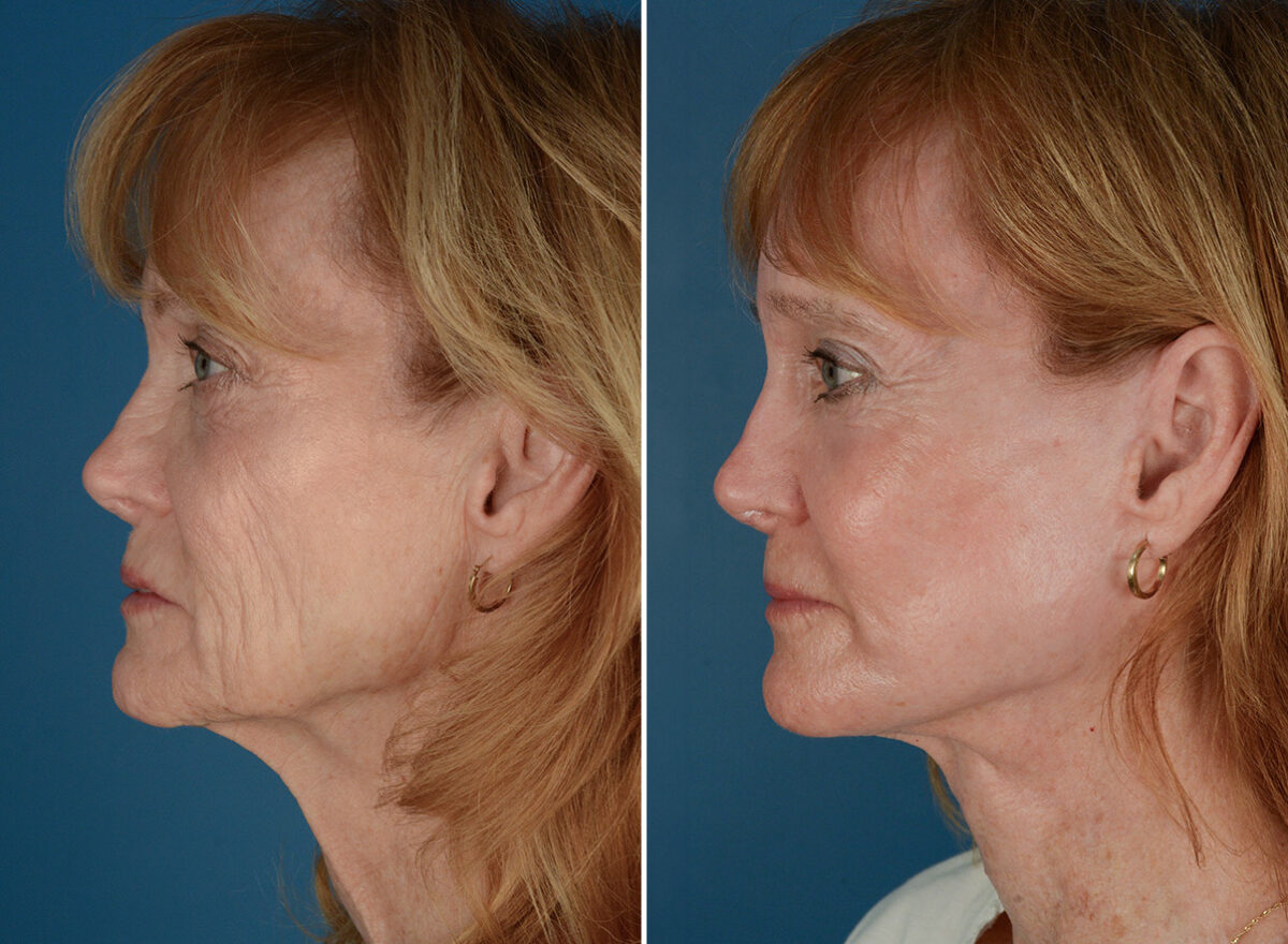 Cheek Implants Before and After Photos in Naples, FL, Patient 26083