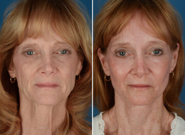 Cheek Implants Before and After Photos in Naples, FL, Patient 26083