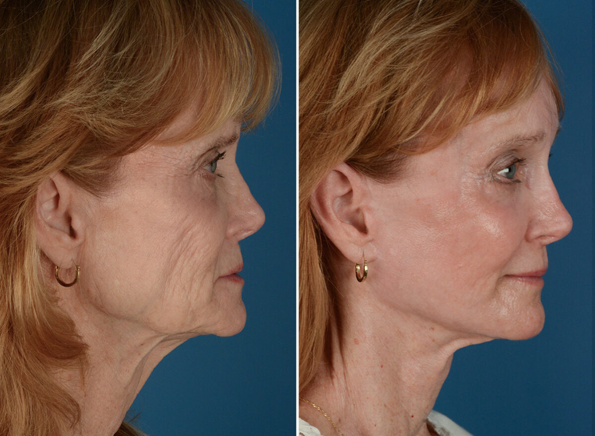 Cheek Implants Before and After Photos in Naples, FL, Patient 26083