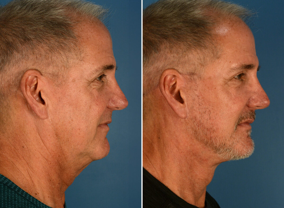The UpLift™ Lower Face and Neck Lift Before and After Photos in Naples, FL, Patient 26099