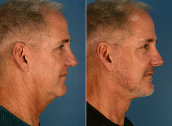 The UpLift™ Lower Face and Neck Lift Before and After Photos in Naples, FL, Patient 26099