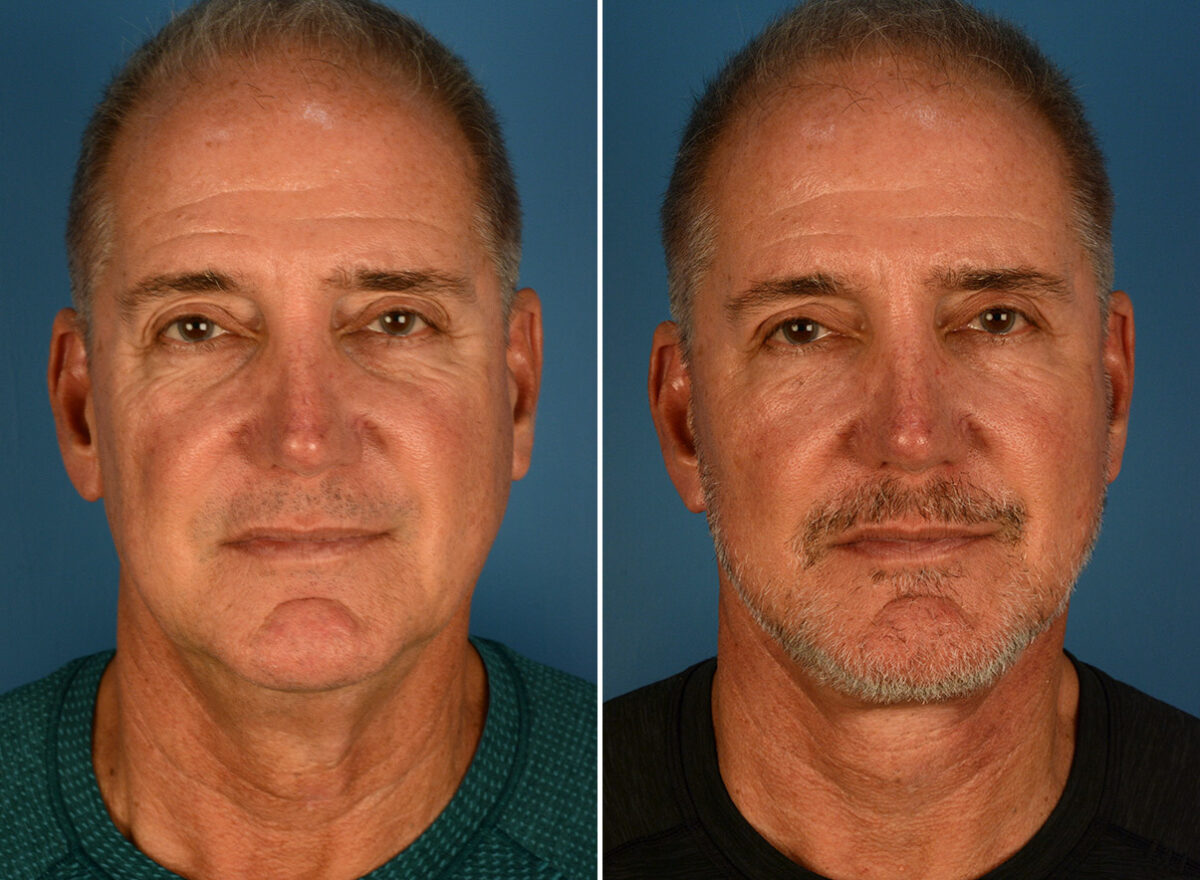 The UpLift™ Lower Face and Neck Lift Before and After Photos in Naples, FL, Patient 26099