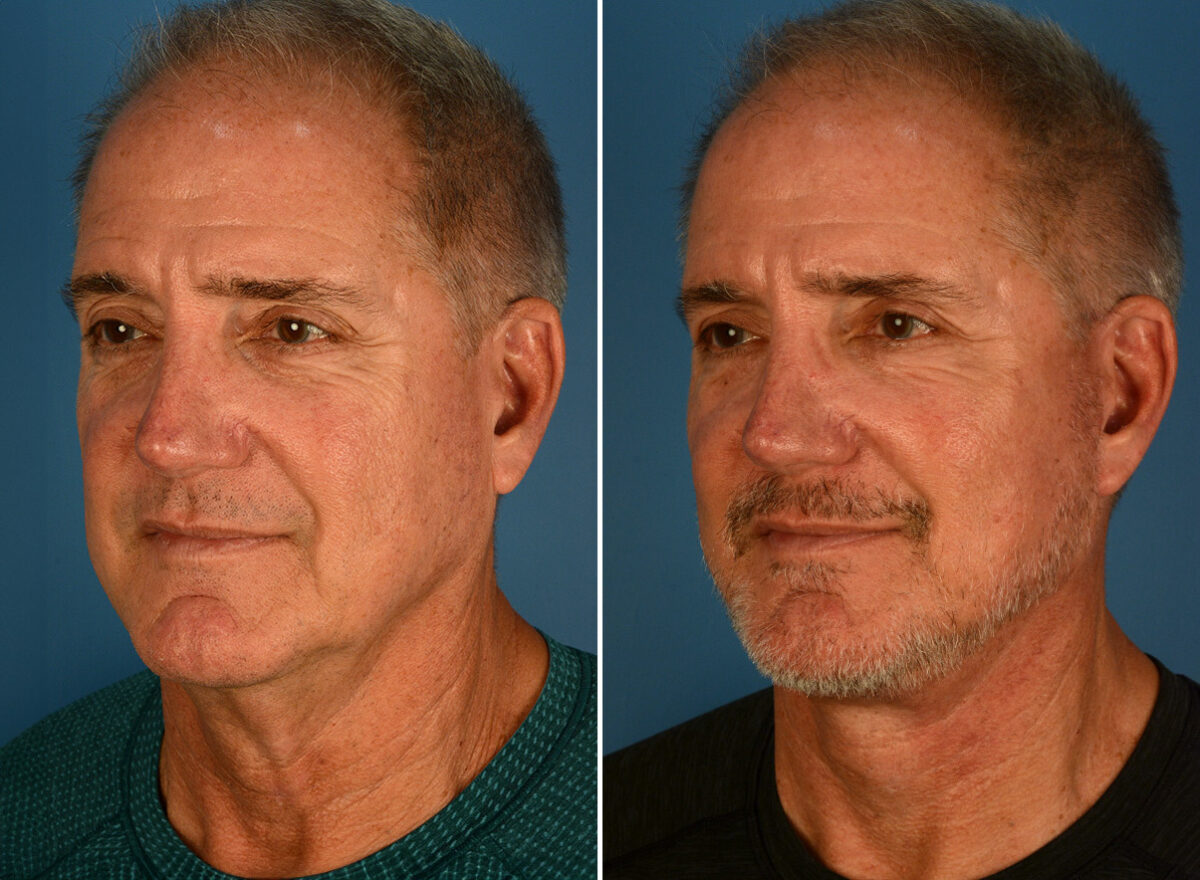 The UpLift™ Lower Face and Neck Lift Before and After Photos in Naples, FL, Patient 26099