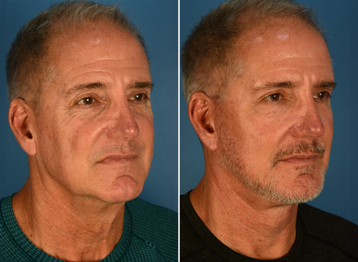 The UpLift™ Lower Face and Neck Lift Before and After Photos in Naples, FL, Patient 26099