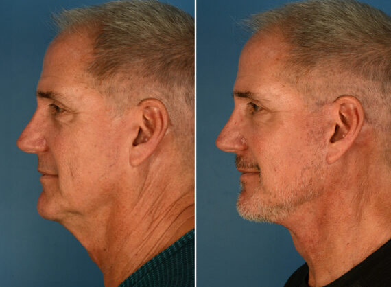 The UpLift™ Lower Face and Neck Lift Before and After Photos in Naples, FL, Patient 26099