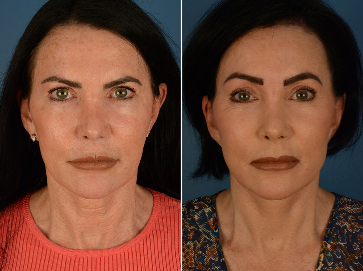 Eyebrow & Forehead Before and After Photos in , , Patient 26129