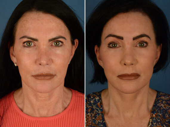 Eyebrow & Forehead Before and After Photos in , , Patient 26129