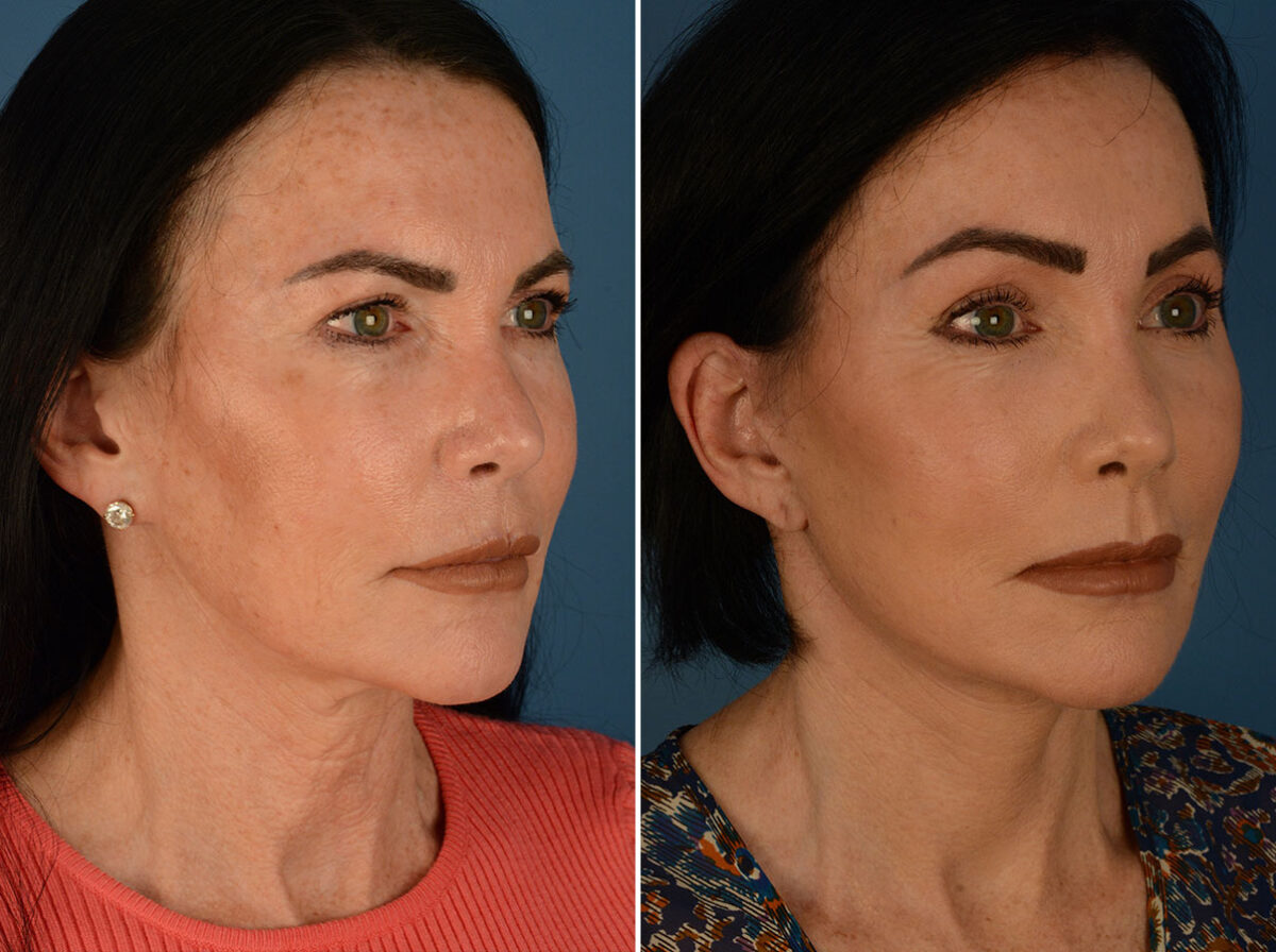 Eyebrow & Forehead Before and After Photos in , , Patient 26129