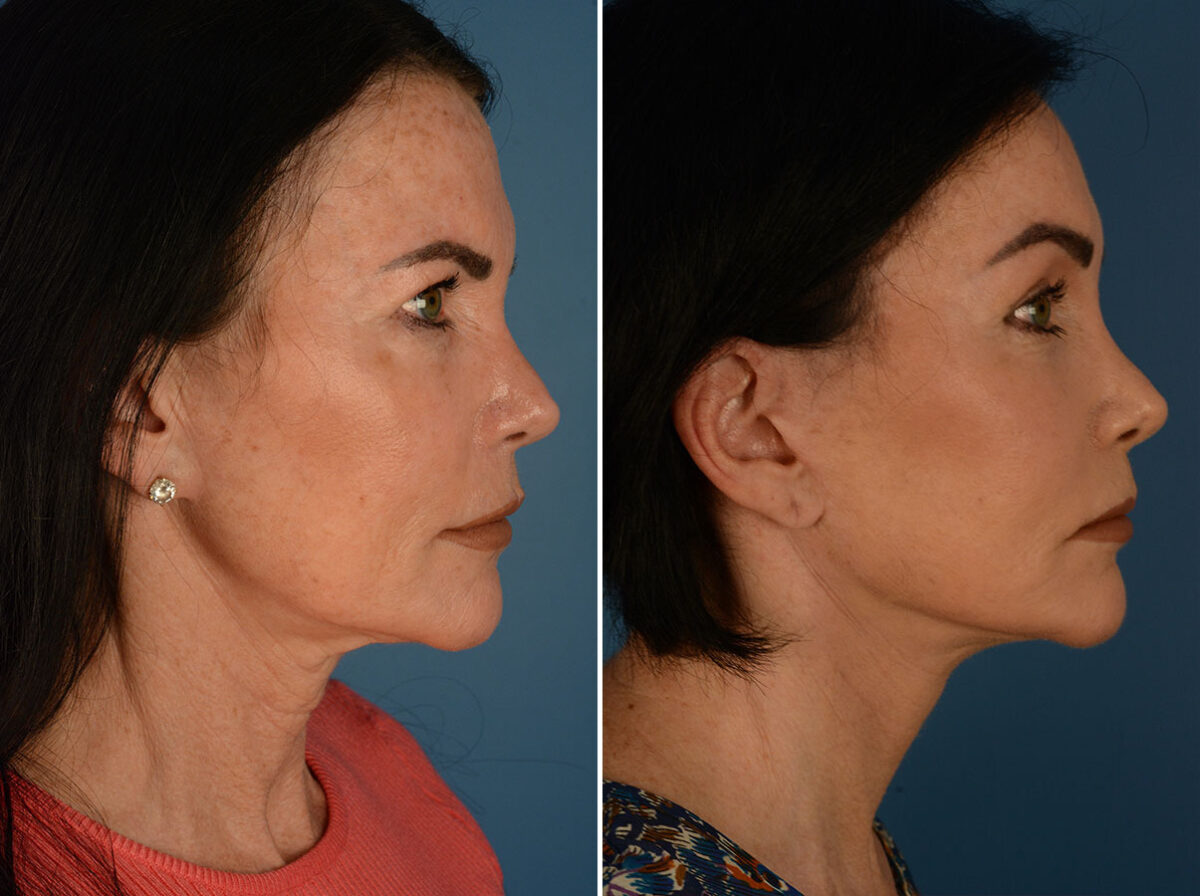 Eyebrow & Forehead Before and After Photos in , , Patient 26129