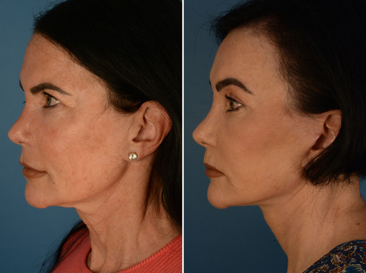Eyebrow & Forehead Before and After Photos in , , Patient 26129