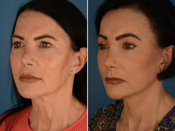 Eyebrow & Forehead Before and After Photos in , , Patient 26129