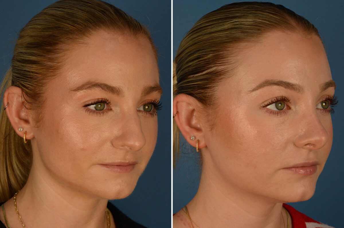 Rhinoplasty Before and After Photos in Naples, FL, Patient 26189