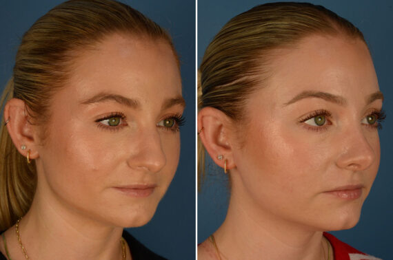 Rhinoplasty Before and After Photos in Naples, FL, Patient 26189