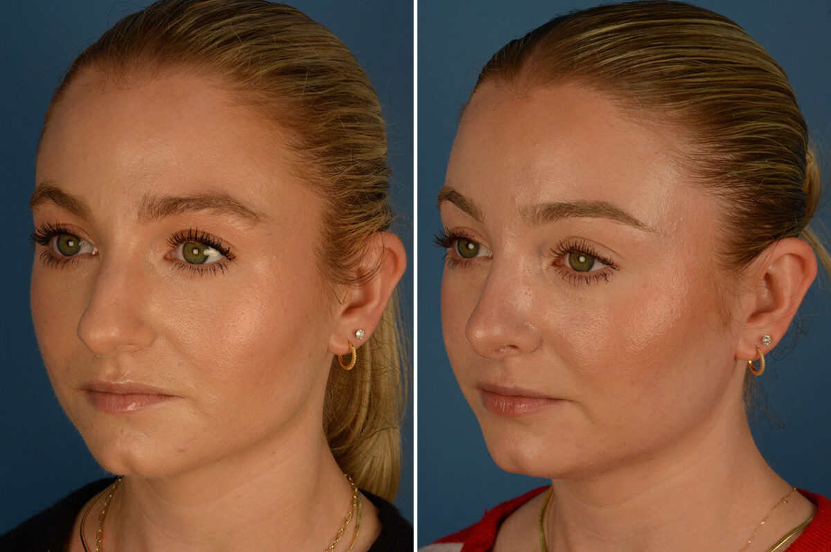 Rhinoplasty Before and After Photos in Naples, FL, Patient 26189