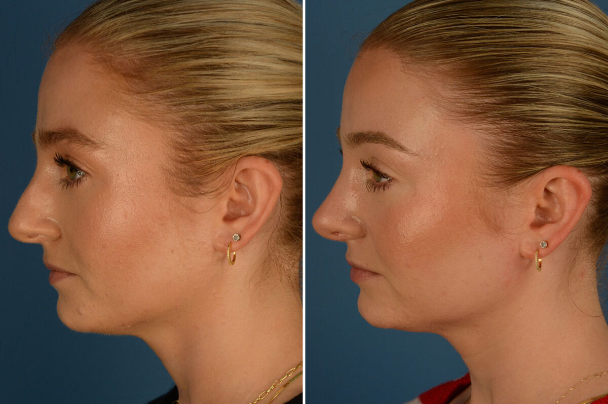 Rhinoplasty Before and After Photos in Naples, FL, Patient 26189