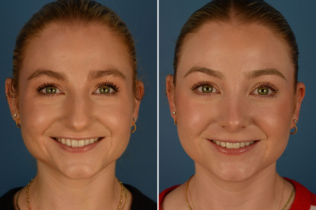 Rhinoplasty Before and After Photos in Naples, FL, Patient 26189