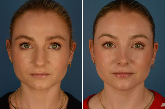 Rhinoplasty Before and After Photos in Naples, FL, Patient 26189