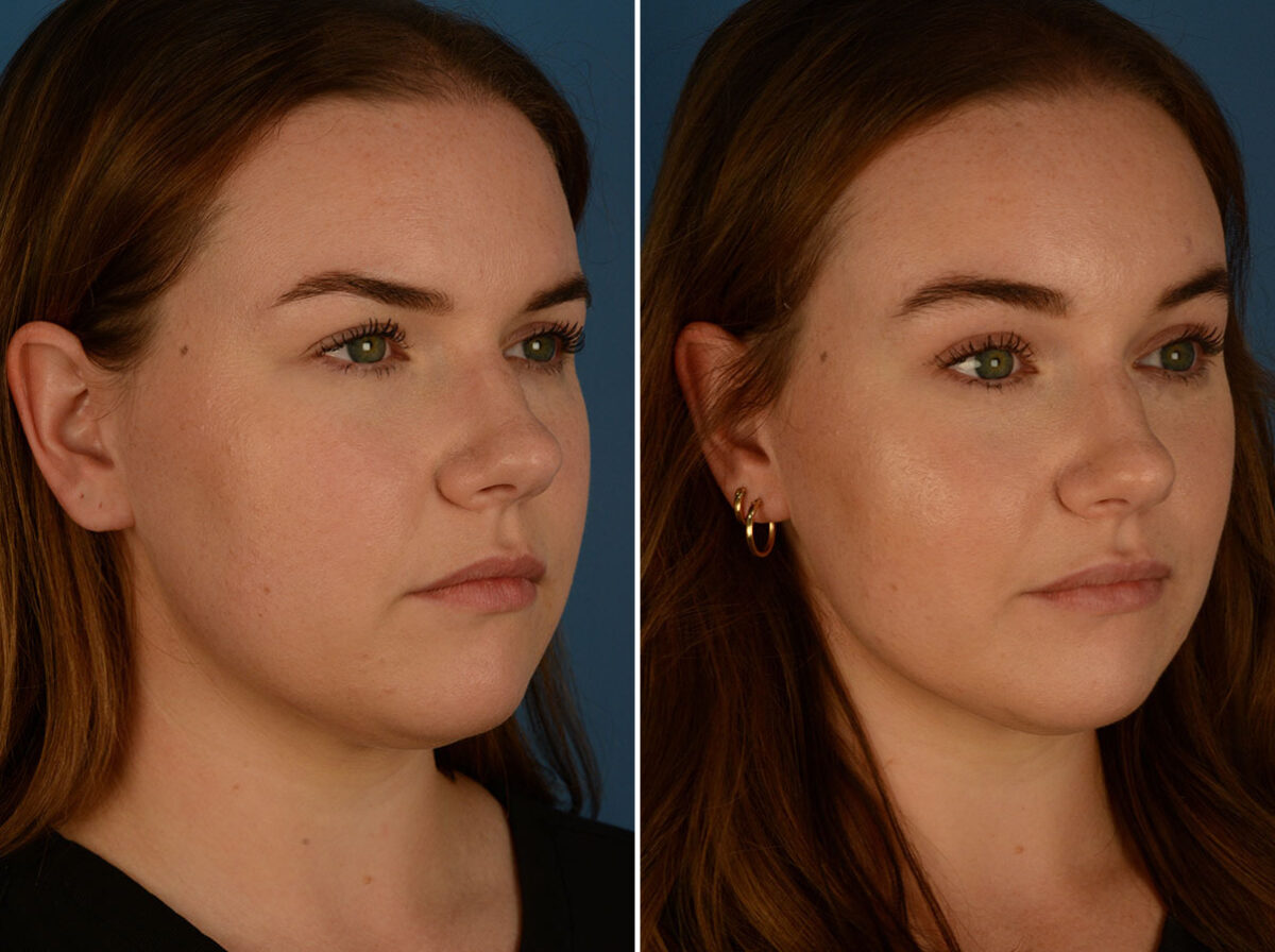 Eyebrow & Forehead Before and After Photos in Naples, FL, Patient 26266