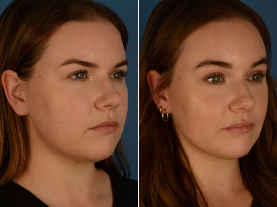 Eyebrow & Forehead Before and After Photos in Naples, FL, Patient 26266
