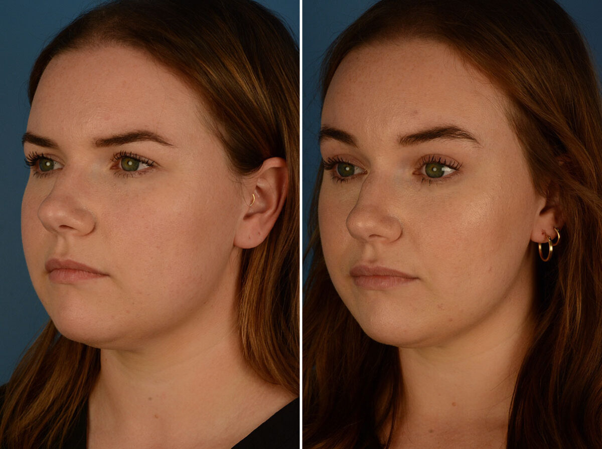 Eyebrow & Forehead Before and After Photos in Naples, FL, Patient 26266