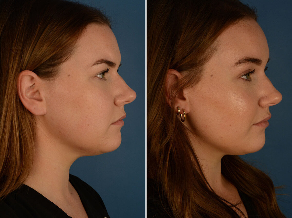 Eyebrow & Forehead Before and After Photos in Naples, FL, Patient 26266