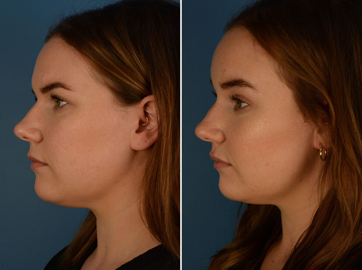 Eyebrow & Forehead Before and After Photos in Naples, FL, Patient 26266