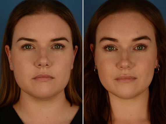 Eyebrow & Forehead Before and After Photos in Naples, FL, Patient 26266