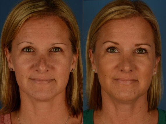 Revision Rhinoplasty Before and After Photos in Naples, FL, Patient 26286