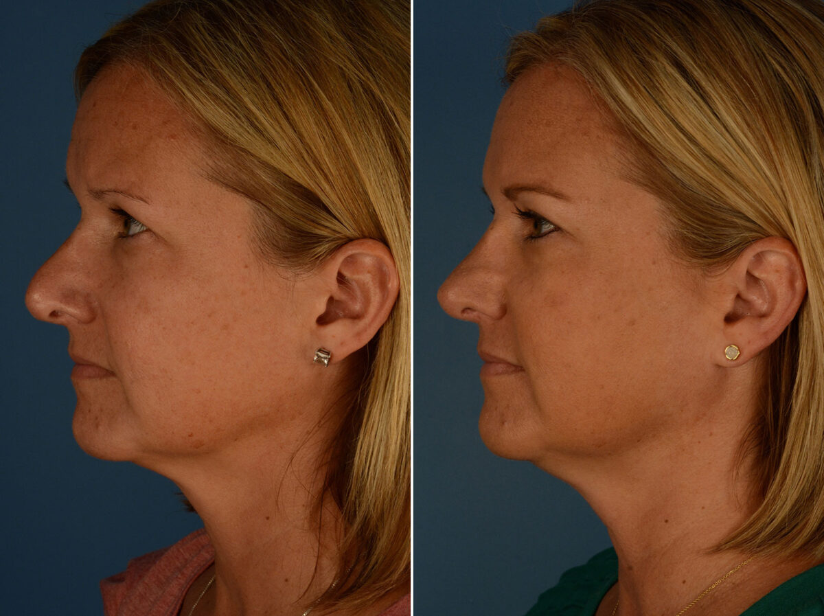 Revision Rhinoplasty Before and After Photos in Naples, FL, Patient 26286