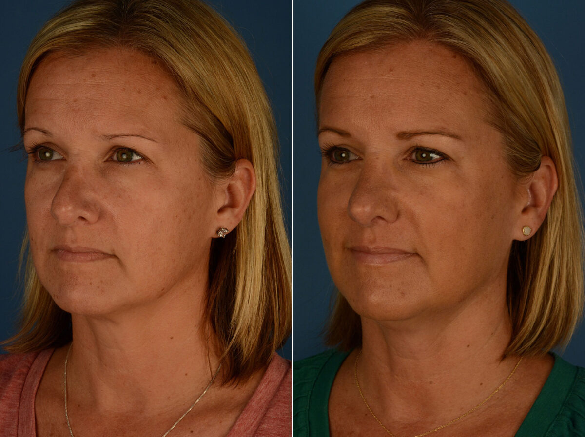 Revision Rhinoplasty Before and After Photos in Naples, FL, Patient 26286