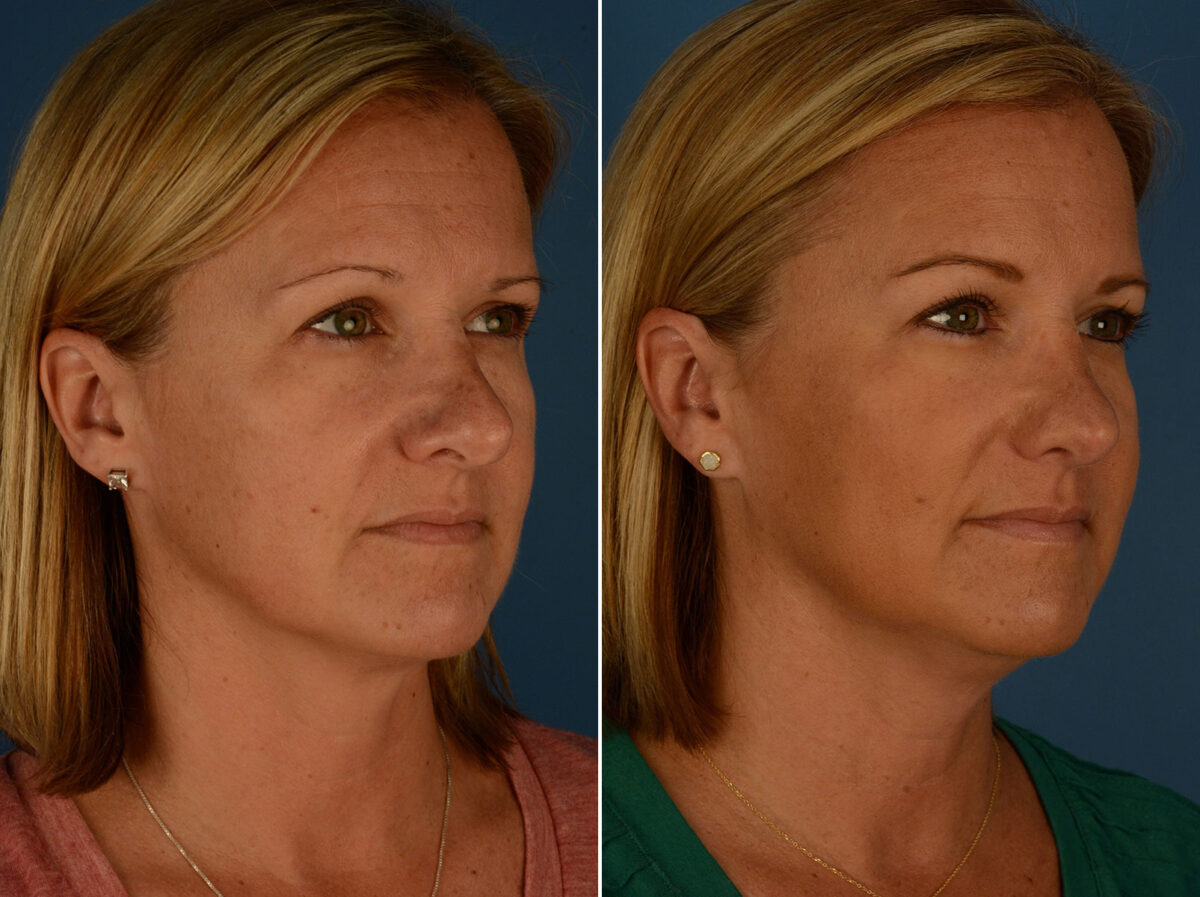 Revision Rhinoplasty Before and After Photos in Naples, FL, Patient 26286