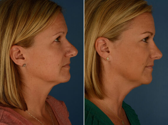 Revision Rhinoplasty Before and After Photos in Naples, FL, Patient 26286