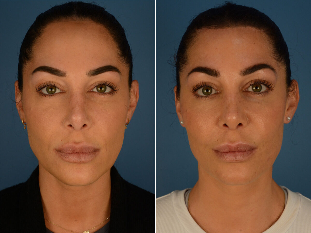 Hairline Lowering/Forehead Reduction Before and After Photos in Naples, FL, Patient 26368
