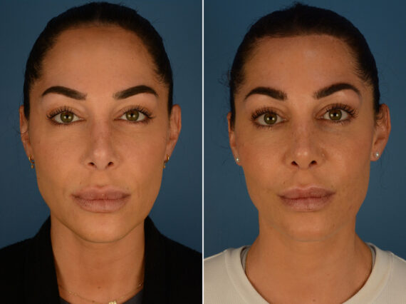 Hairline Lowering/Forehead Reduction Before and After Photos in Naples, FL, Patient 26368