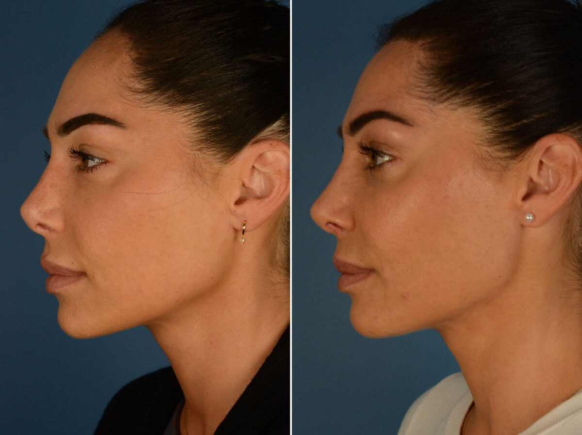 Hairline Lowering/Forehead Reduction Before and After Photos in Naples, FL, Patient 26368