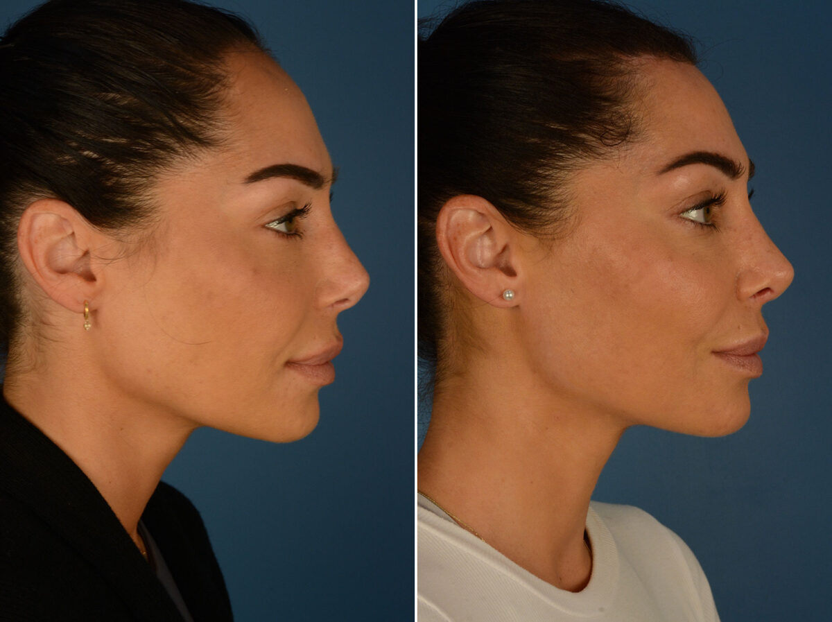 Hairline Lowering/Forehead Reduction Before and After Photos in Naples, FL, Patient 26368