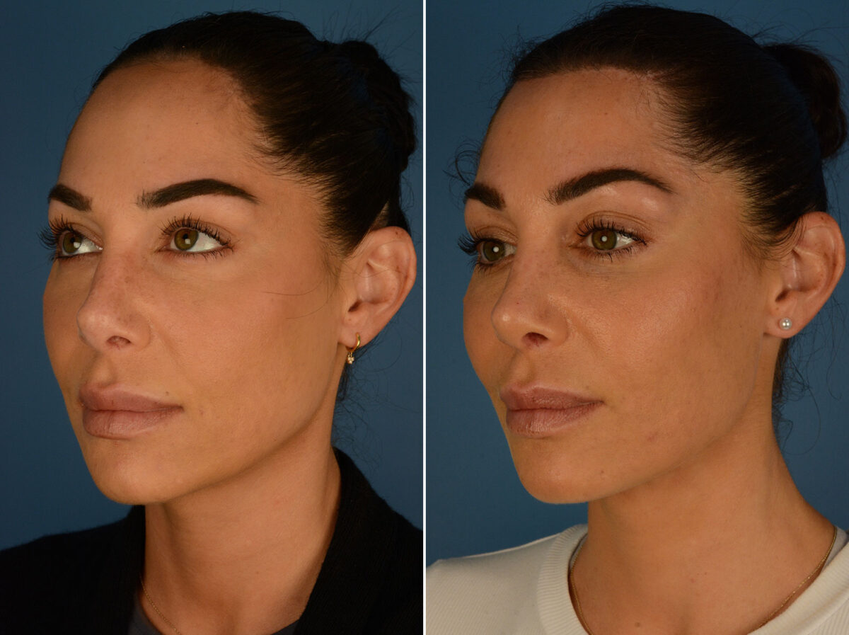 Hairline Lowering/Forehead Reduction Before and After Photos in Naples, FL, Patient 26368
