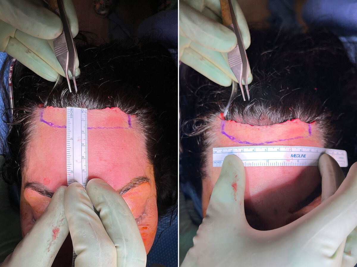 Hairline Lowering/Forehead Reduction Before and After Photos in Naples, FL, Patient 26368