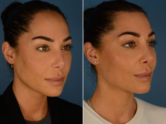 Hairline Lowering/Forehead Reduction Before and After Photos in Naples, FL, Patient 26368