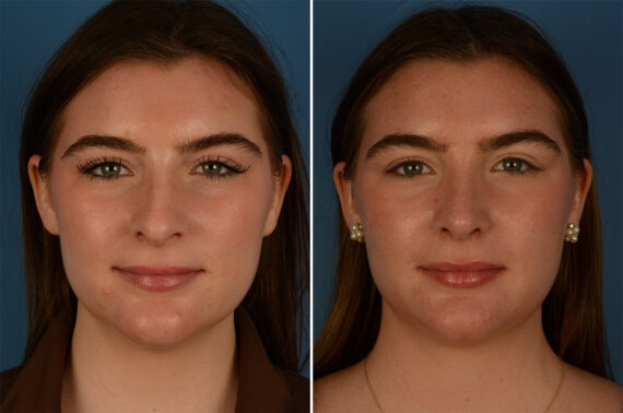 Rhinoplasty Before and After Photos in Naples, FL, Patient 26830