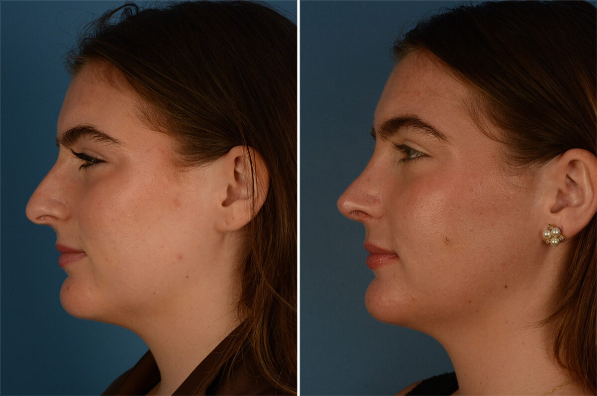 Rhinoplasty Before and After Photos in Naples, FL, Patient 26830