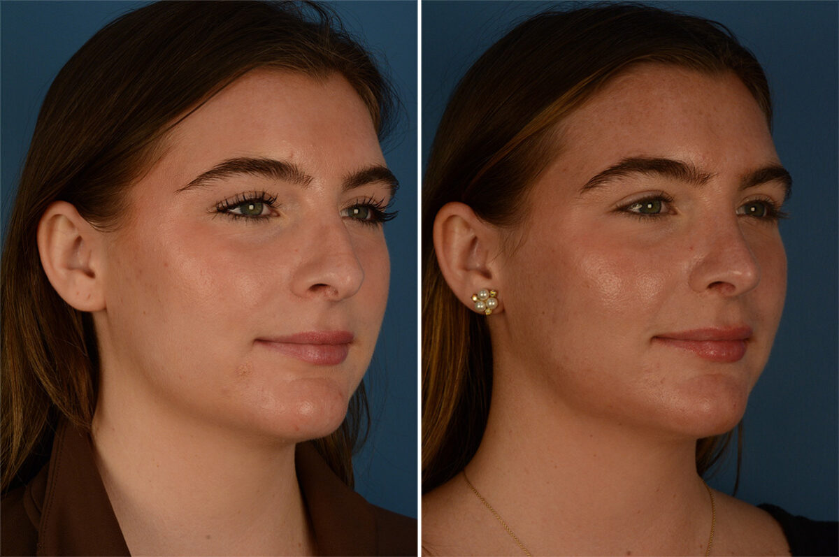 Rhinoplasty Before and After Photos in Naples, FL, Patient 26830