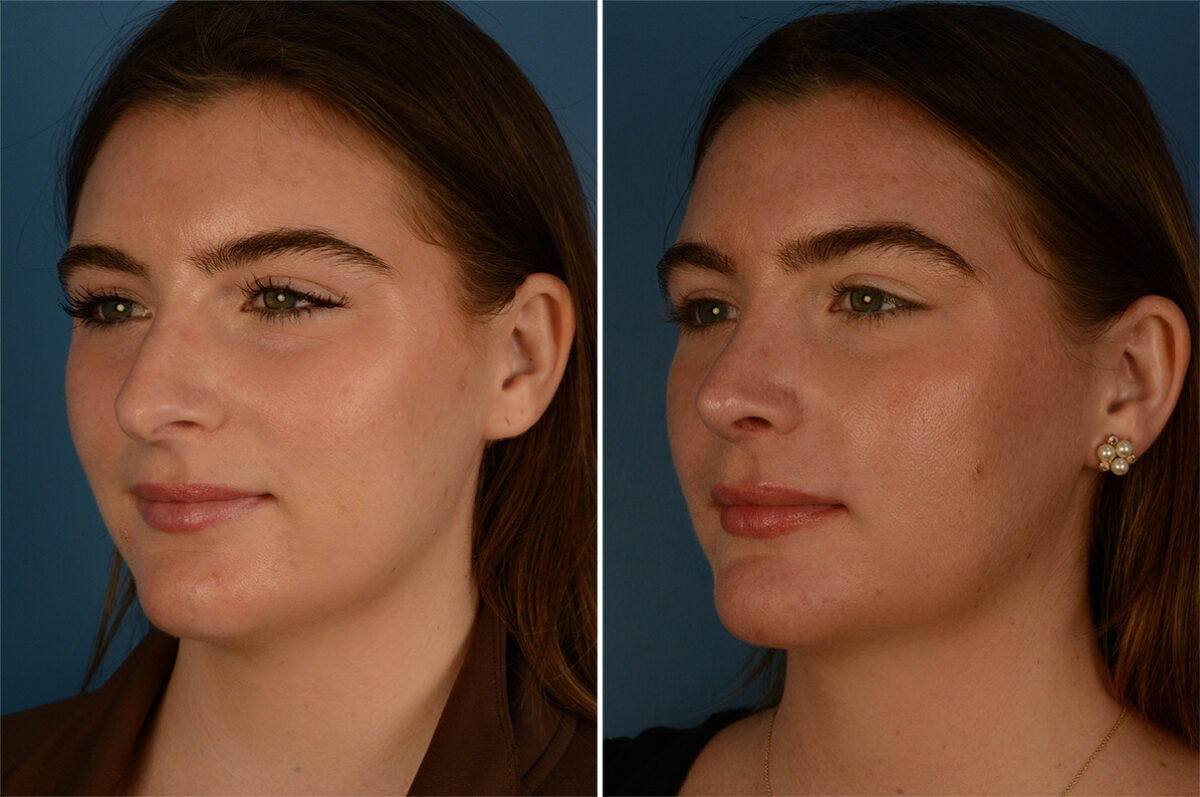Rhinoplasty Before and After Photos in Naples, FL, Patient 26830