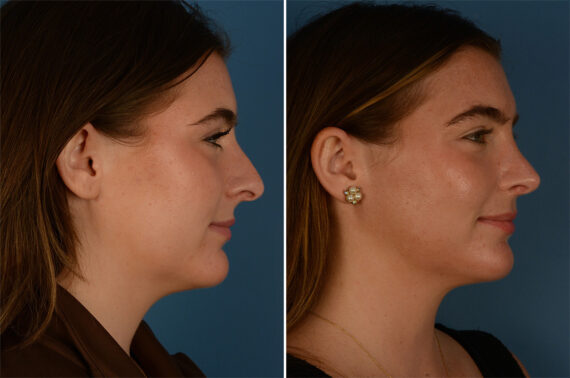 Rhinoplasty Before and After Photos in Naples, FL, Patient 26830