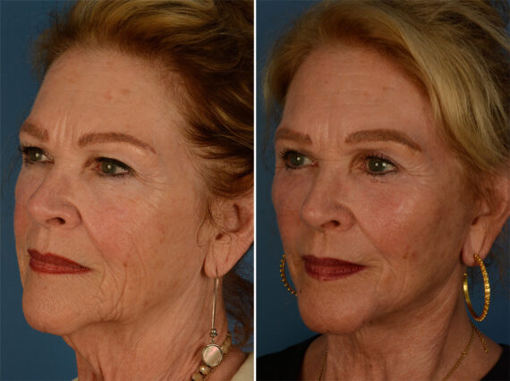 The UpLift™ Lower Face and Neck Lift Before and After Photos in Naples, FL, Patient 26854