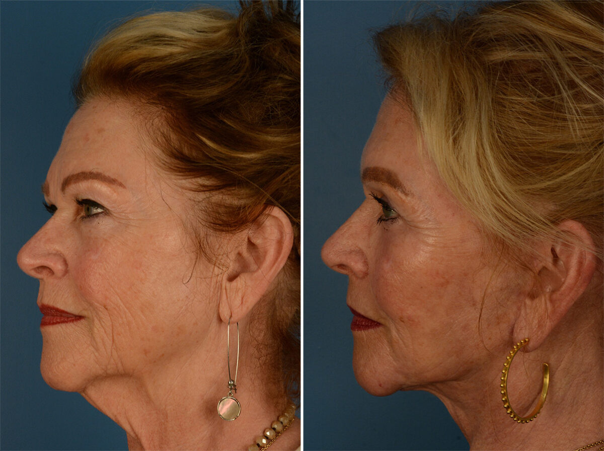 The UpLift™ Lower Face and Neck Lift Before and After Photos in Naples, FL, Patient 26854